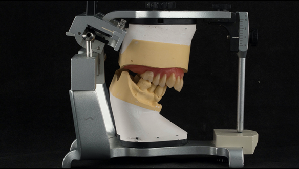 Figure 90 Mk 2 teeth wax try in with Schottlander Enigmalife teeth in centric relation position determined by central bearing apparatus.