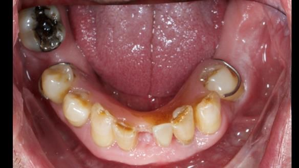 Newsletter 86 Peter the Architect — precision removable partial dentures case study