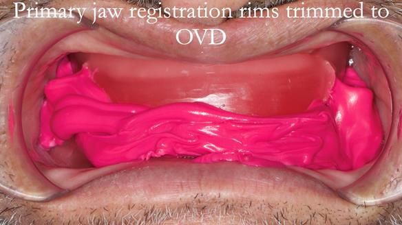 Managing poor implant positioning with complete dentures and Locator attachments - full protocol Newsletter 41