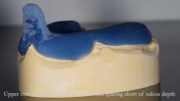 Newsletter 77: Jeremy’s case – immediate complete upper denture