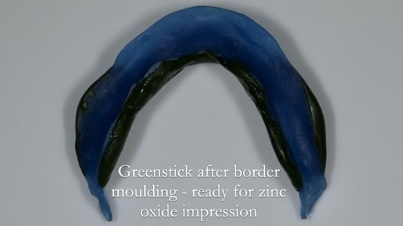 Newsletter 80 - Gordon’s dentures: the one case in 1,000 where my technique failed