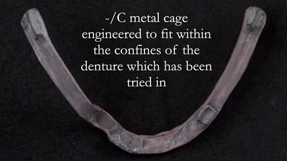 Managing poor implant positioning with complete dentures and Locator attachments - full protocol Newsletter 41