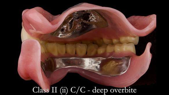 Complete denture Class II div 2 deep overbite Newsletter 39