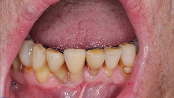 Newsletter 54 case presentation upper complete denture and lower Scandinavian designed hygienic partial denture for David