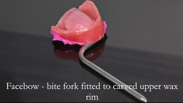 The bite fork is attached to the wax rim is be used to mount the upper working cast on the articulator