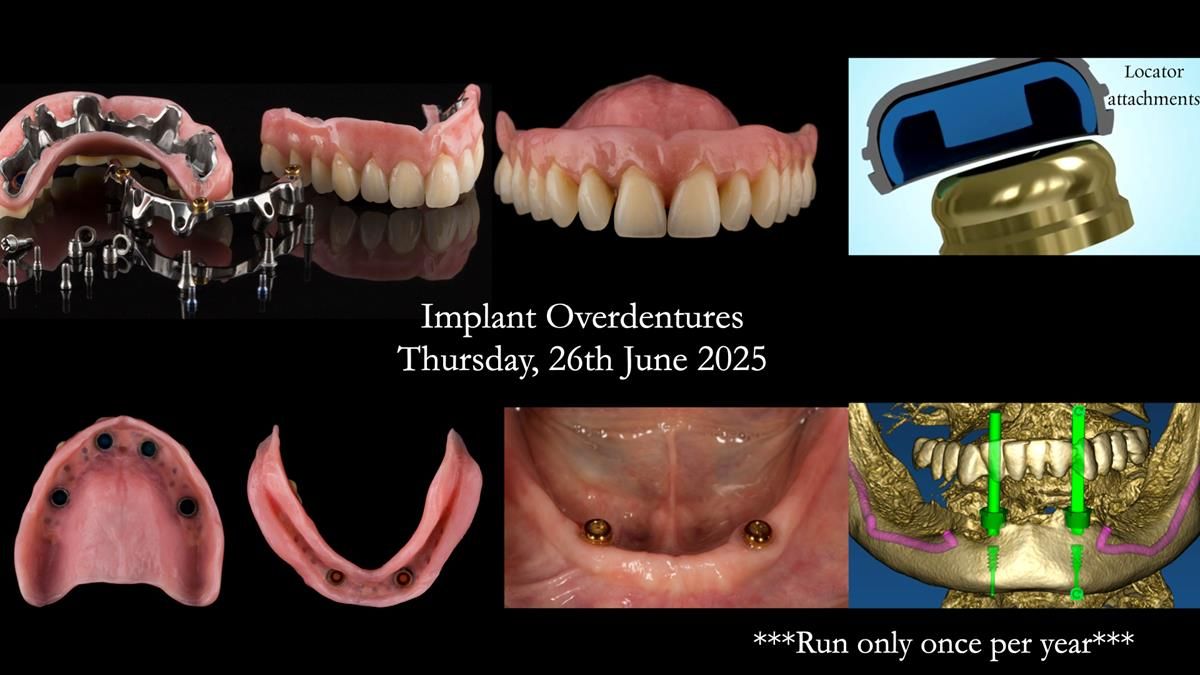 Newsletter 78: What do Clark Gable and a Locator® overdenture have in common?