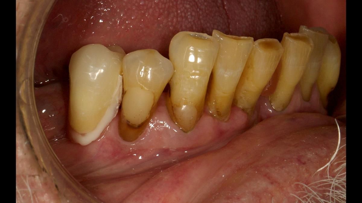 Newsletter 87 – Father Peter: A Partial Denture that needed Minor Miracle