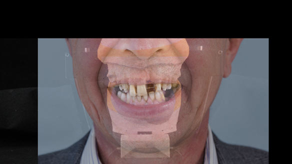 Figure 23 Superimposed photograph of the pretreatment smile onto the mounted casts