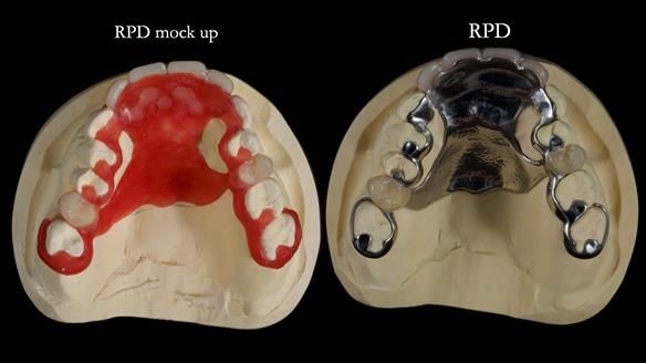 Newsletter 81 - Pam’s Story — how a partial denture changed her life (+ live walkthrough this Thursday)