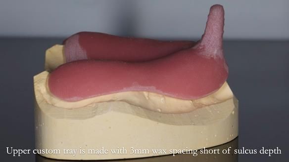 Newsletter 54 case presentation upper complete denture and lower Scandinavian designed hygienic partial denture for David