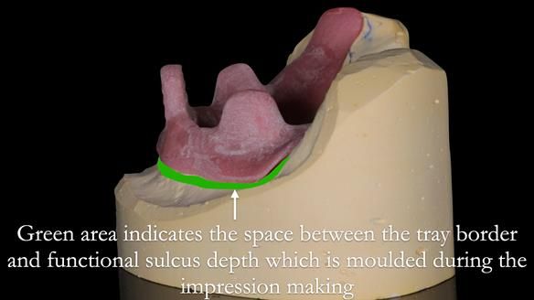 Newsletter 50 Special edition Complete Dentures FULL PROTOCOL