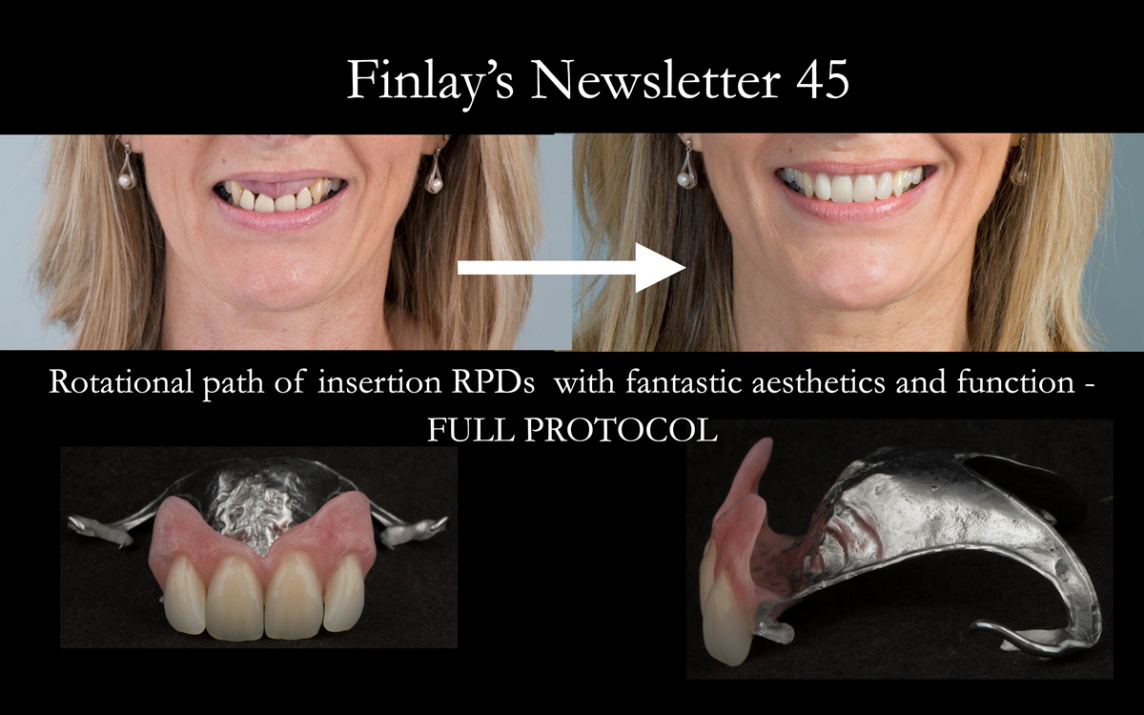 Rotational path of insertion RPDs with fantastic aesthetics FULL PROTOCOL