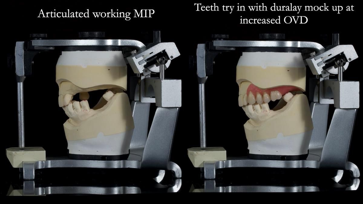 Newsletter 89 – Simon: A Challenging Kennedy Class II Division 1 Upper CoCr Partial Denture with a High Smile Line
