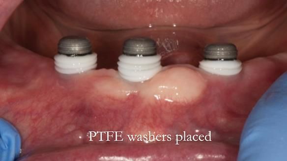 PTFE washers placed to prevent the cold cure acrylic from setting onto the locator abutments. If these are not used the denture will lock in place - needing drilling out.
