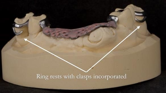 Eileen's transformation with upper and lower RPDs of Scandinavian hygienic design FULL PROTOCOL