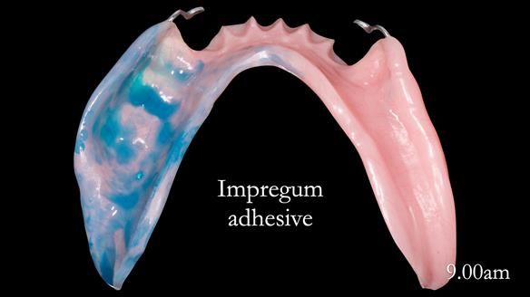 Newsletter 52 Managing Jo’s failing dentition with extractions and Mk 1/Mk 2 complete upper dentures and lower partial dentures FULL PROTOCOL