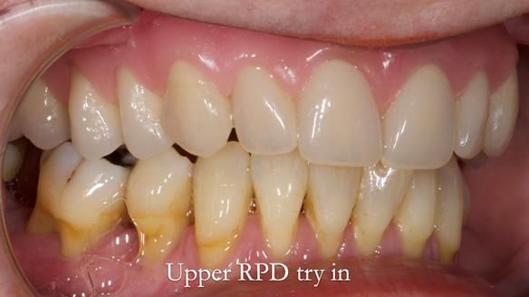 Finlay's Newsletter 58 Gasket upper partial denture for Zoe