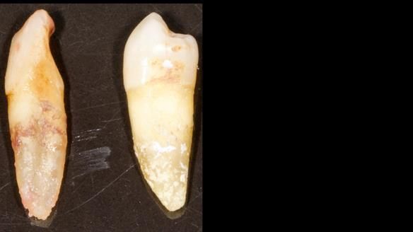 Newsletter 86 Peter the Architect — precision removable partial dentures case study