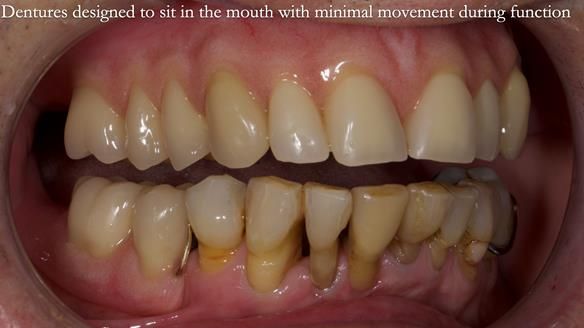 Newsletter 54 case presentation upper complete denture and lower Scandinavian designed hygienic partial denture for David