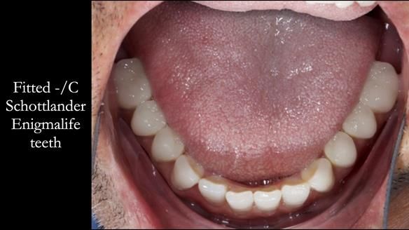 Managing poor implant positioning with complete dentures and Locator attachments - full protocol Newsletter 41
