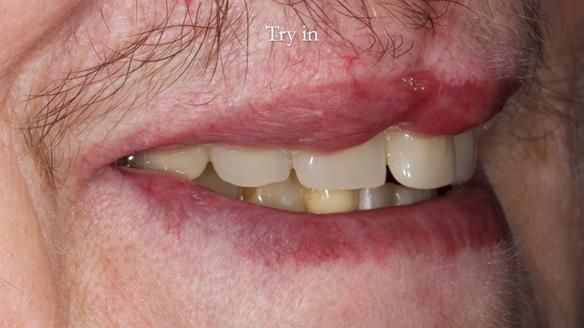 Newsletter 55 Provision of metal based partial dentures for Zephyrine with a repaired cleft lip and palate