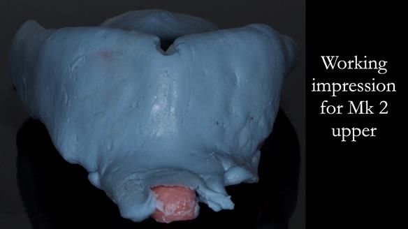 Finlay's Case Study Newsletter 40 - Immediate Mk 1 RPD to Definitive Mk 2 RPD - full protocol