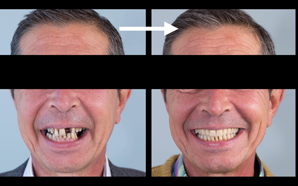 Figure 119 Before treatment and after with Mk 2 maxillary cobalt chromium based complete denture and mandibular cobalt chromium based partial denture fitted