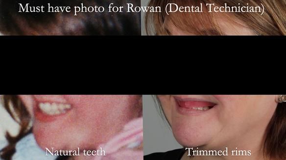 Finlay's Newsletter 58 Gasket upper partial denture for Zoe