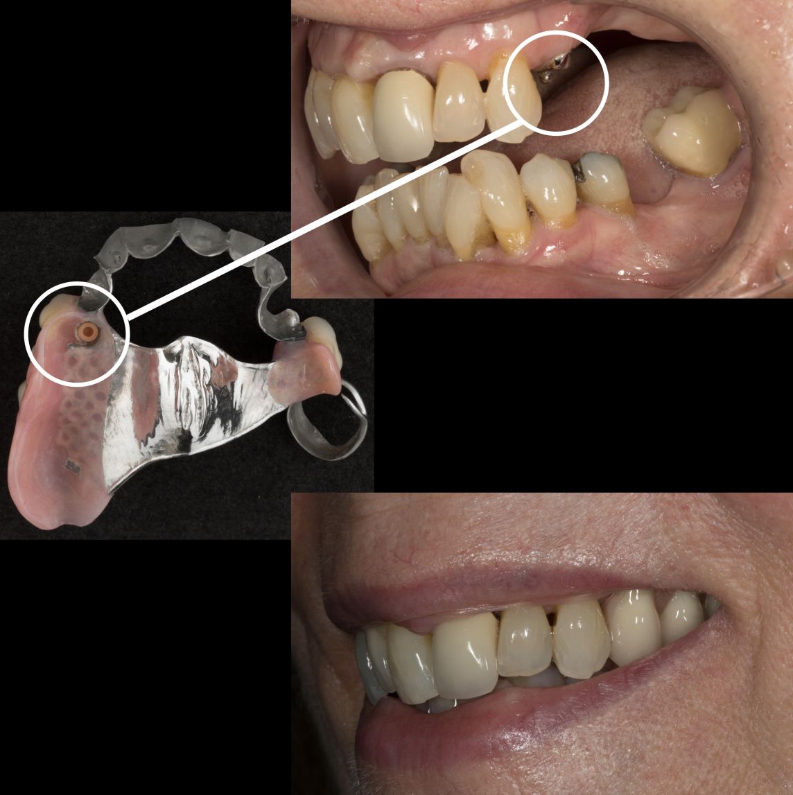 Precision attachments are rarely needed for partial dentures