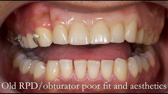 Acrylic based partial denture/obturator had poor, retention and support Obturator section was in poor condition. The Adams clasp were causing inflammation of the gingival margins. The clasp on the UR3 was visible resulting in poor appearance. Reduced lip