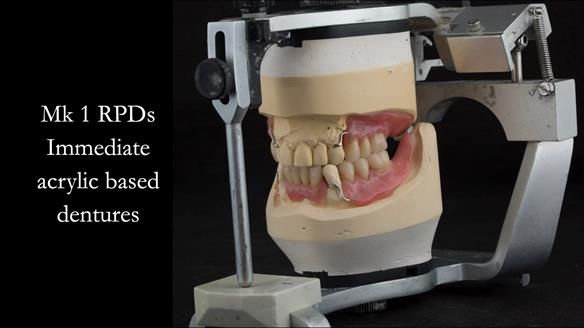 Finlay's Case Study Newsletter 40 - Immediate Mk 1 RPD to Definitive Mk 2 RPD - full protocol