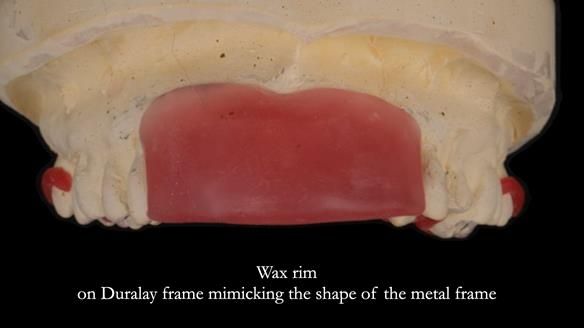 Finlay's Newsletter 63 Case study provision of metal based Scandinavian RPD - functional 10 years on