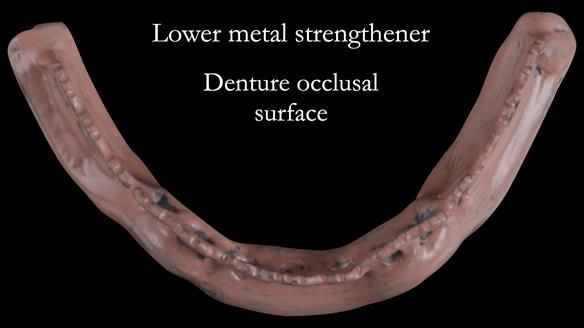 Newsletter 50 Special edition Complete Dentures FULL PROTOCOL