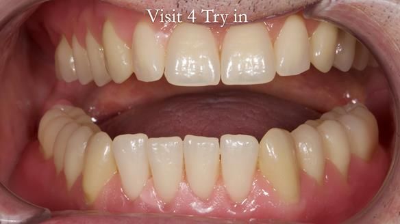 Newsletter 80 - Gordon’s dentures: the one case in 1,000 where my technique failed