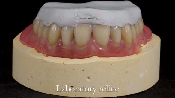 Finlay's Newsletter 62 provision of extractions and metal based complete dentures for Rafique