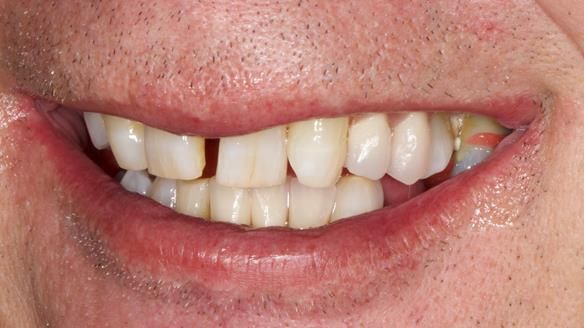 Newsletter 86 Peter the Architect — precision removable partial dentures case study