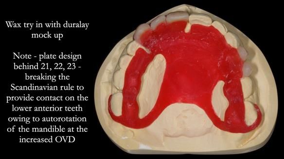 Read Newsletter 67 - Brian's COMBAT DENTURE Case Study