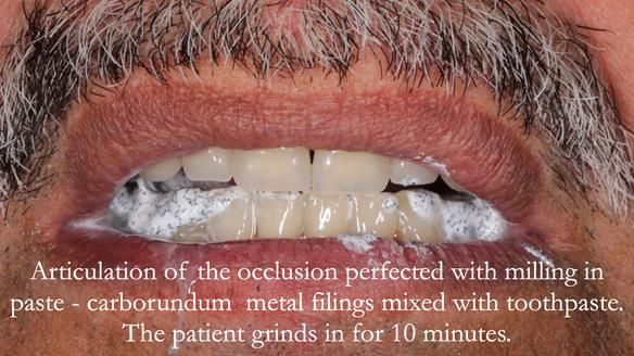 Finlay's Newsletter 62 provision of extractions and metal based complete dentures for Rafique