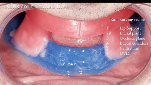 Newsletter 80 - Gordon’s dentures: the one case in 1,000 where my technique failed