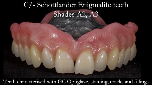 Newsletter 57 showcases the making and fitting process of implant-supported complete dentures for Alisdair