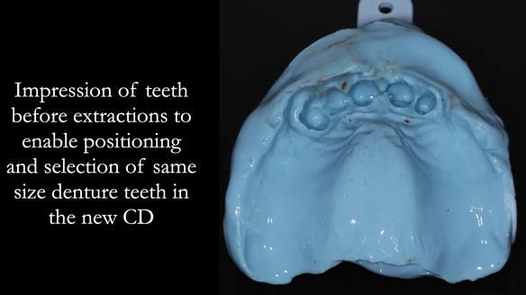 Finlay's Newsletter 62 provision of extractions and metal based complete dentures for Rafique