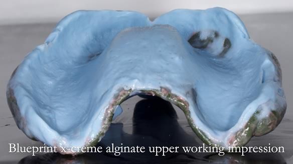 Newsletter 53 showing the making and fitting of ultra life-like dentures for Valena