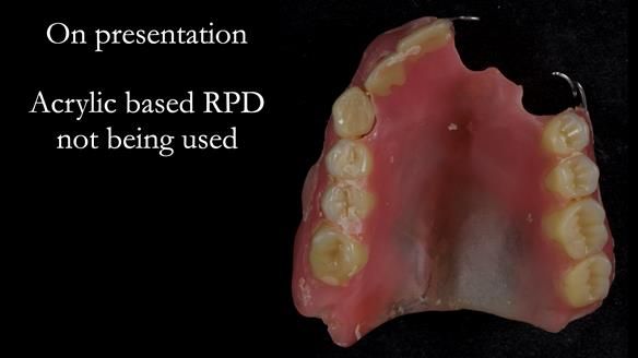 Newsletter 55 Provision of metal based partial dentures for Zephyrine with a repaired cleft lip and palate
