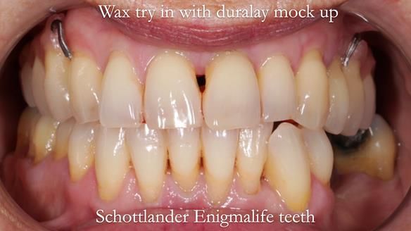 Newsletter 56 showing the making and fitting of a bilateral free end saddle upper removable partial denture (RPD) for patient with pemphigus
