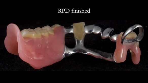 Newsletter 55 Provision of metal based partial dentures for Zephyrine with a repaired cleft lip and palate