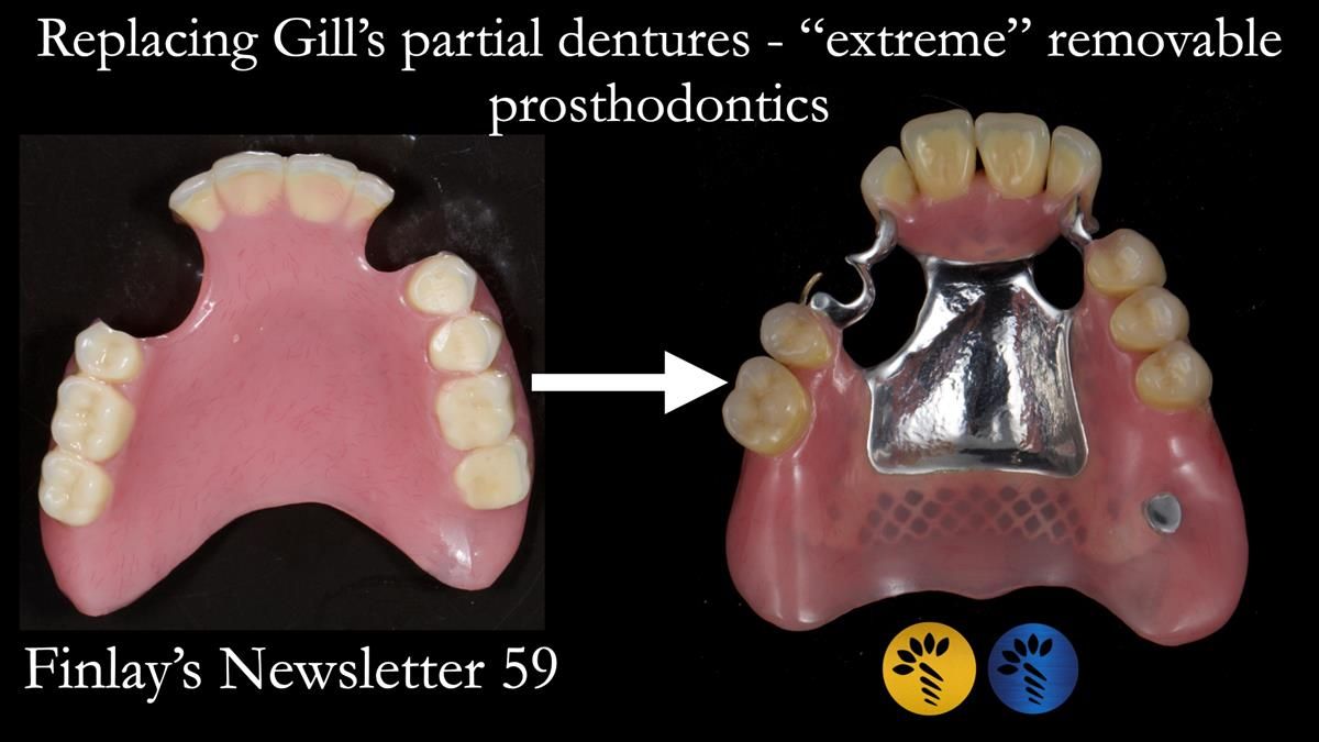 Finlay's Newsletter 59 Ultra hard partial dentures made for Gill
