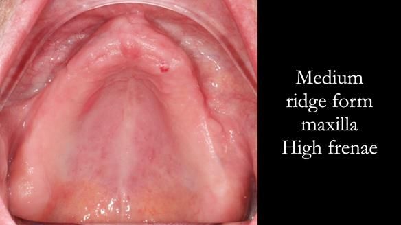 Newsletter 54 case presentation upper complete denture and lower Scandinavian designed hygienic partial denture for David
