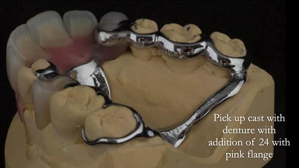 Finlay's Newsletter 63 Case study provision of metal based Scandinavian RPD - functional 10 years on