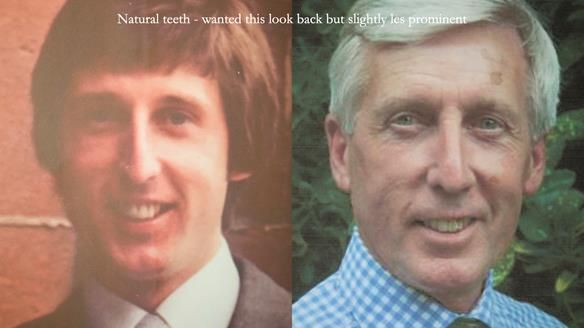 Newsletter 77: Jeremy’s case – immediate complete upper denture