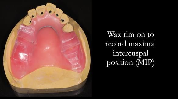 Newsletter 56 showing the making and fitting of a bilateral free end saddle upper removable partial denture (RPD) for patient with pemphigus